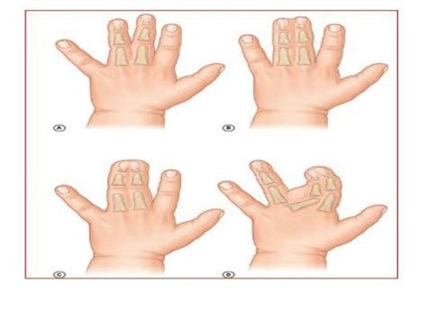 Congenital Anomalies Of Upper Limb