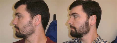 Patchy Sides Four Months Into First Beard Vs One Year Plus Of Growing