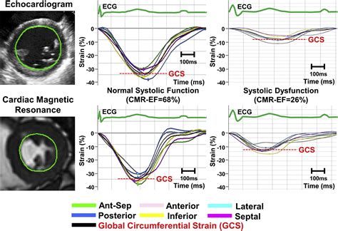 Global Longitudinal Strain And Global Circumferential Strain By Speckle