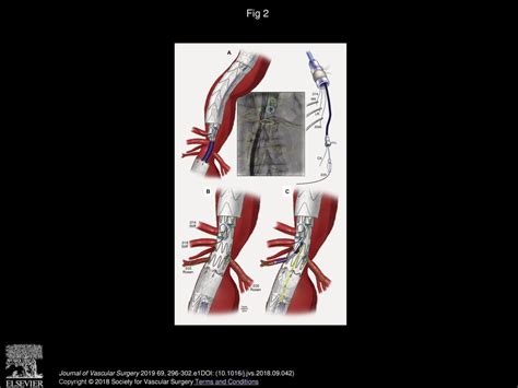 Technical Video Of Endovascular Repair Of Chronic Postdissection Thoracoabdominal Aortic