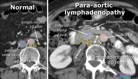 Ct Abdomen General