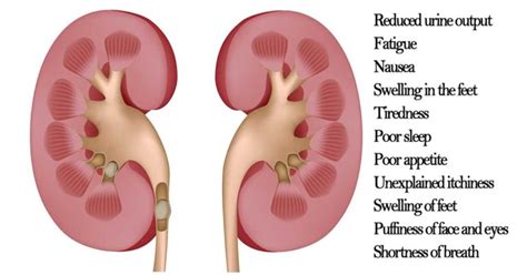 11 Kidney Cancer Symptoms (and How To Manage It Naturally)