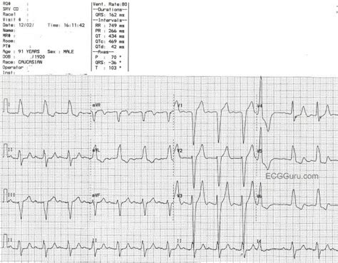 Aortic stenosis | ECG Guru - Instructor Resources