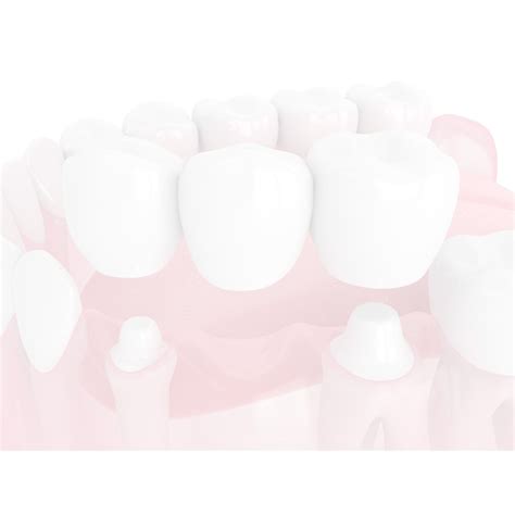 Porcelain Bridges | Dental Dental | Cedar Creek Dental