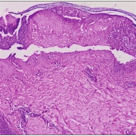 Microphotograph Of Erythema Multiforme Showing Dermoepidermal Download Scientific Diagram