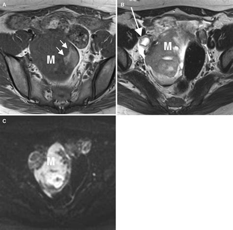 Magnetic Resonance Imaging Features Of Ovarian Fibroma Fibrothecoma And Thecoma Springerlink