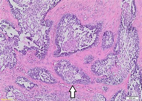 Ameloblastoma Of The Mandible Analysis Of Radiographic And