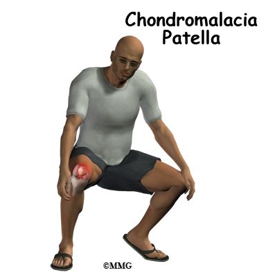 Chondromalacia Patella - eOrthopod.com