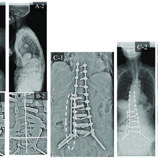 Case Study Rr And Sd A Preoperative Standing Whole Spine