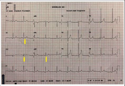 Electrocardiogram ECG Shows Normal Sinus Rhythm With ST Elevation In