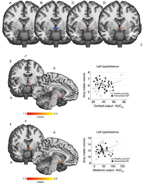 Results From Voxel Based Morphometry Analyses Showing Overlap Between