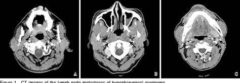 Figure 1 From Analysis Of Cervical And Retropharyngeal Lymph Node