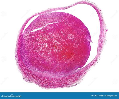 thrombus  blood vessel light micrograph stock photography