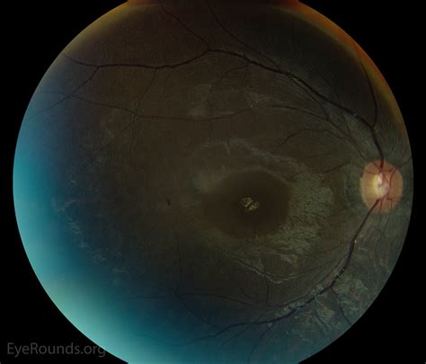 Bull S Eye Maculopathy Due To Hydroxychloroquine Toxicity