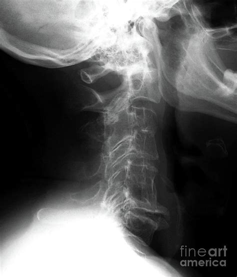 Osteoarthritis Of The Cervical Spine Photograph By Zephyrscience Photo Library Fine Art America