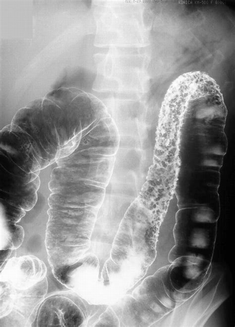 Cobblestone Appearance In The Colon Of A 24 Year Old Man Gut