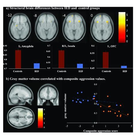 Functional Magnetic Resonance Imaging Fmri Result Of Whole Brain