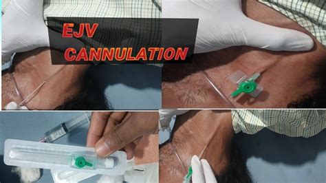 External Jugular Vein Cannulation