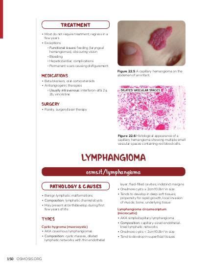 Lymphangioma | Osmosis