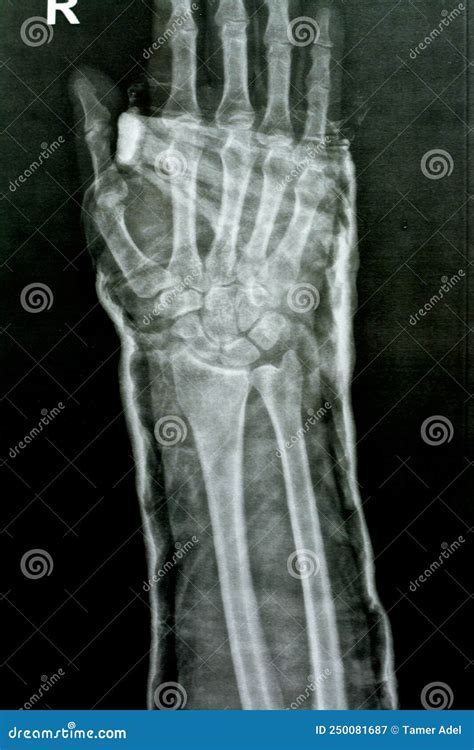 Plain X Ray Right Wrist Joint Shows Right Distal Radius Fracture