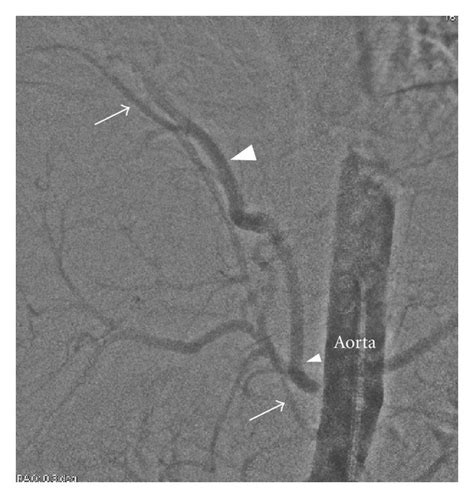 Intra Arterial Digital Subtraction Angiogram Reveals Two Anomalous