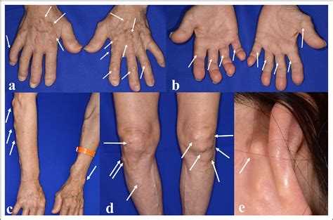 Figure 1 From Unusual Type Of Scleromyxedema With Multiple Subcutaneous