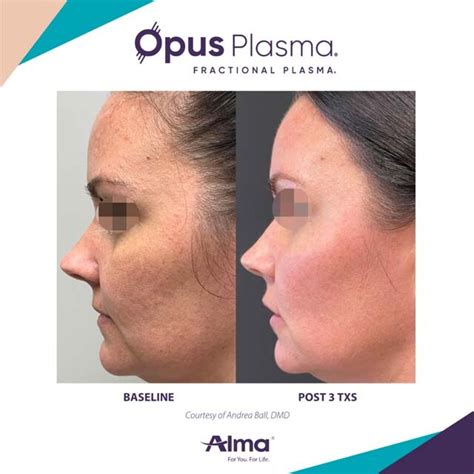 Opus Plasma Skin Tightening Gallery The Beauty Spot In Boulder Colorado