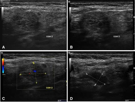 Chronic Sclerosing Sialadenitis Küttners Tumour Of The Submandibular