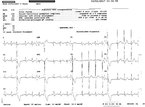 Premature Ventricular Contractions Ecg