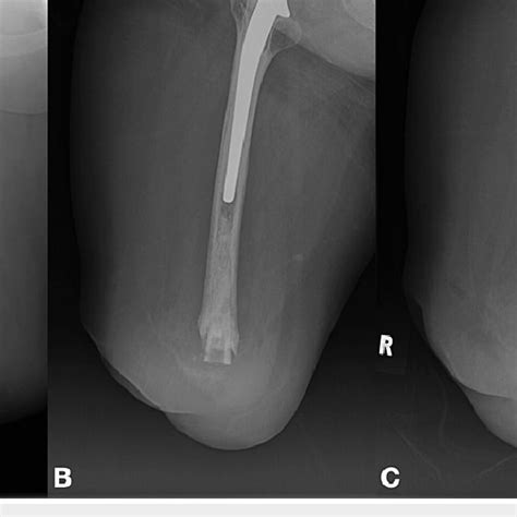 A Anteroposterior X Ray Of The Amputation Stump In The Early