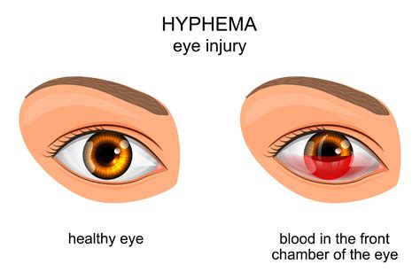 Understanding Hyphema: Symptoms, Treatment & More | NVISION Eye Centers