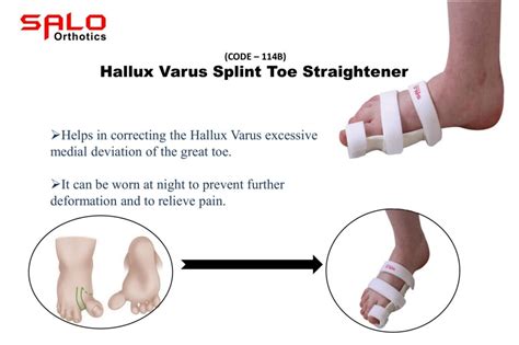 Hallux Varus Splint Toe Straightener - Salo Orthotics