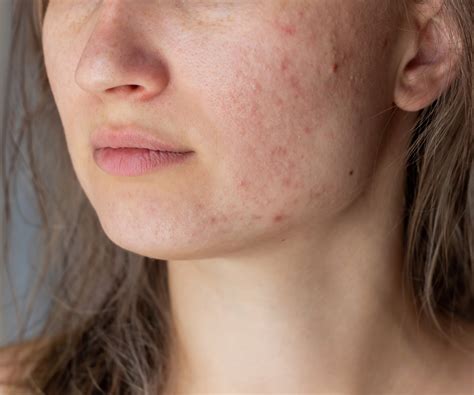 Clearing The Confusion Common Culprits Behind Your Breakouts