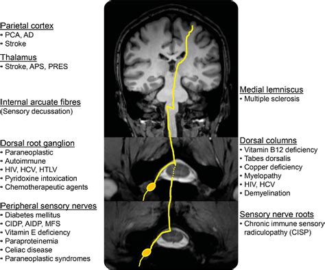 Figure 1 from Reasoning : Reversible gait ataxia From wheelchair to ...