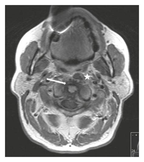 Axial Mri Slice At Initial Presentation Contrast Enhanced T1 Weighted