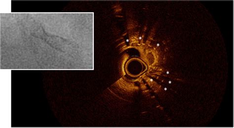 Frontiers Intravascular Imaging In Coronary Stent Restenosis