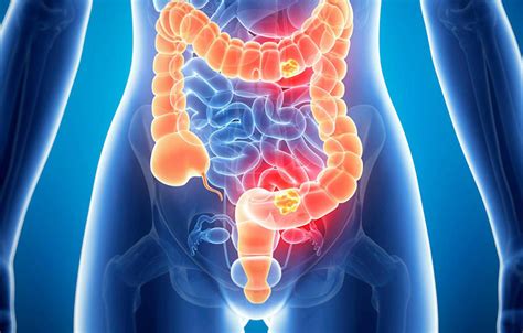 Colon Irritable Causas Síntomas y Tratamiento