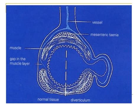 Enfermedad Diverticular Dr Almarza