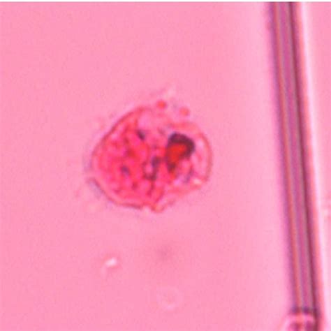 Amoebic Trophozoites Present In The Cerebrospinal Fluid Note The Oval