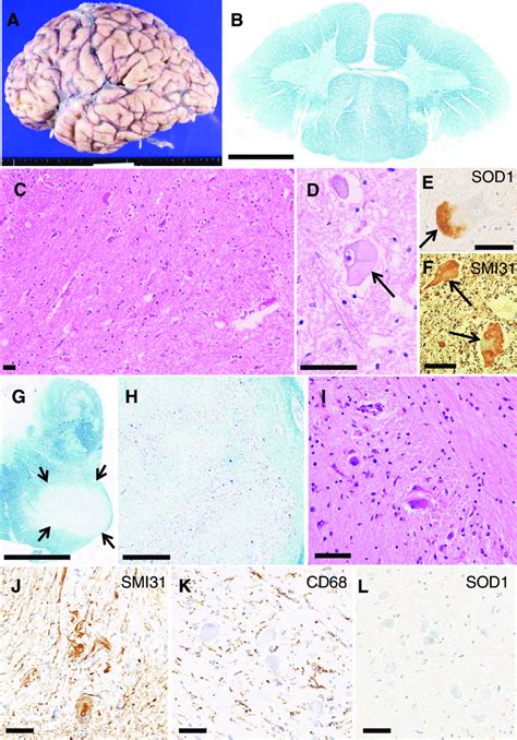 Neuropathological Findings A Macroscopic Appearance Of The Brain