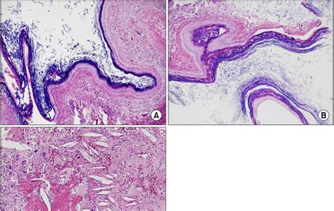 Epidermal Inclusion Cyst Histology