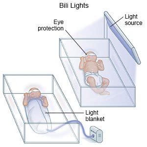 phototherapy  jaundice  newborns