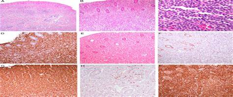 Epstein Barr Virus Negative Marginal Zone Lymphoma As An Unc The