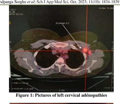 Figure 1 From Cervix Uterine Cancer With Axillary And Neck Lymph Node