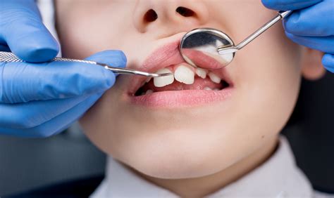 Ortodoncia Infantil Por Qu Es Tan Importante Valvanera Cl Nica Dental