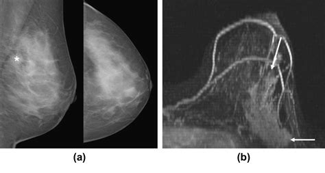 Riskbenefit Analysis Of Preoperative Breast Mri In Patients With