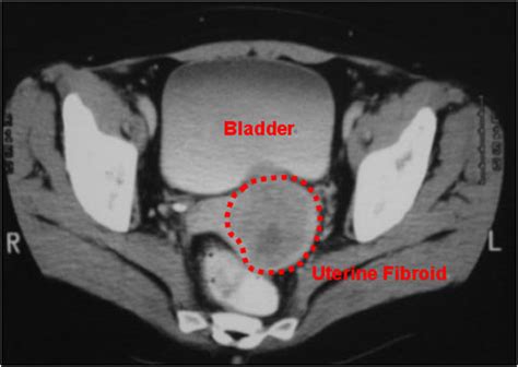 Uterus Toronto Notes