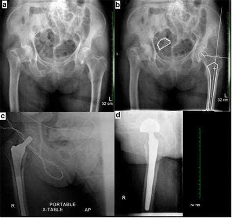 Right low-energy subcapital hip fracture. b Computer software with ...