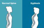 Ways to Diagnose Thoracic Kyphosis Symptoms-YourBodyPosture