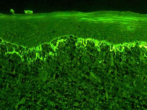 Pathology Outlines - Lichen planus